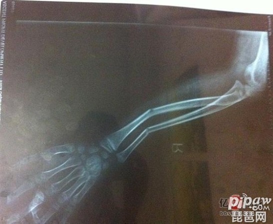 DOTA2 Pis手臂摔伤事件
